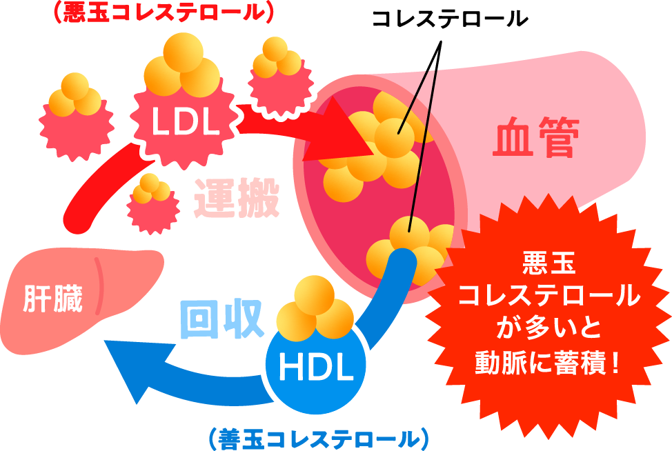 悪玉コレステロールが増えすぎると動脈硬化の危険が！